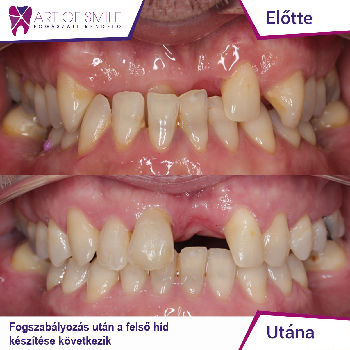 1.fogszabalyozas elotte utana felnott 1112 1